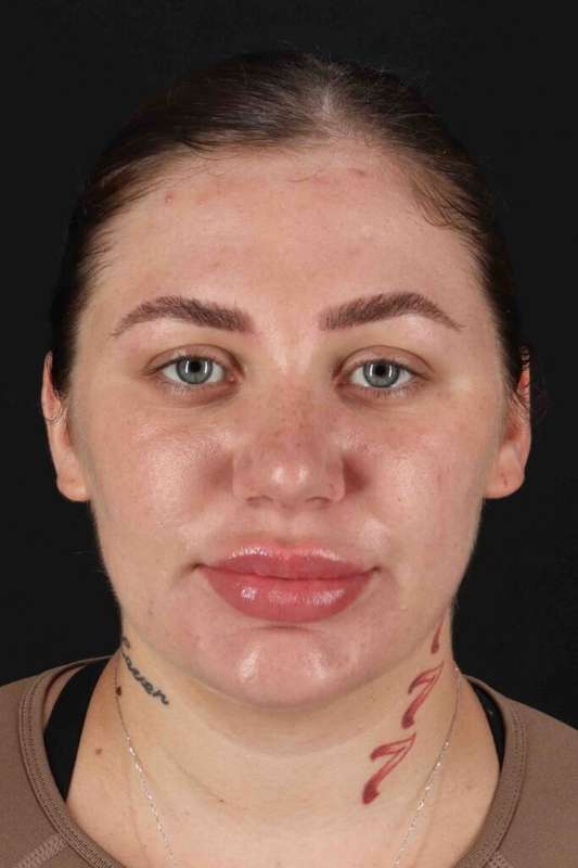 Rhinoplasty Before & After Patient #3104