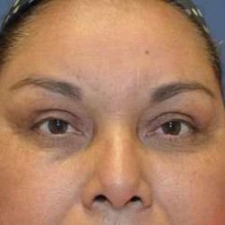 Browlift Before & After Patient #1411