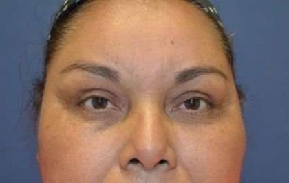 Browlift Before & After Patient #1411