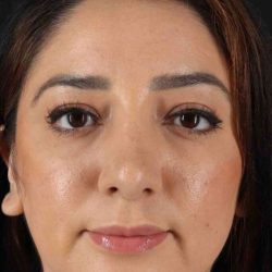 Rhinoplasty Before & After Patient #3115