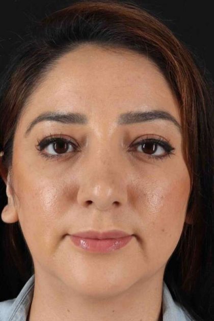 Rhinoplasty Before & After Patient #3115