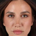 Rhinoplasty Before & After Patient #3137
