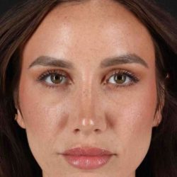 Rhinoplasty Before & After Patient #3137