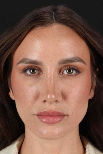 Rhinoplasty Before & After Patient #3137