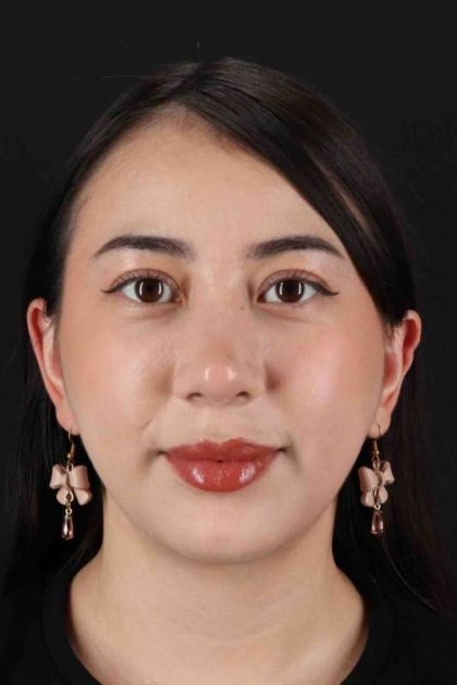 Rhinoplasty Before & After Patient #3159