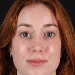 Rhinoplasty Before & After Patient #3170