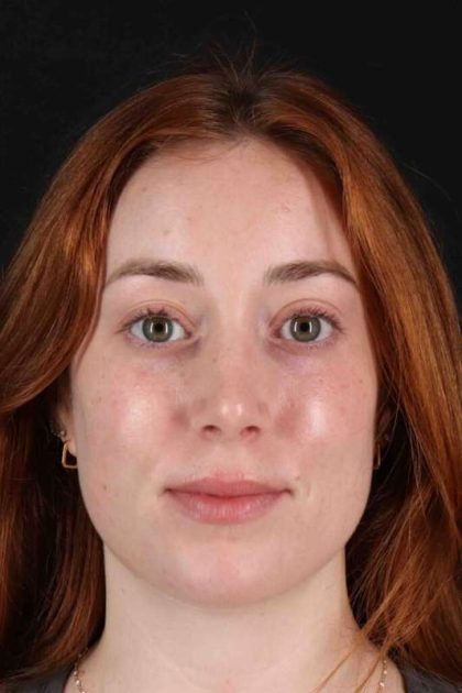 Rhinoplasty Before & After Patient #3170
