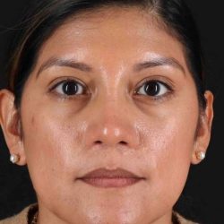 Rhinoplasty Before & After Patient #3181