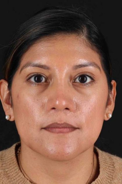 Rhinoplasty Before & After Patient #3181