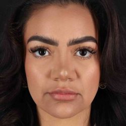 Rhinoplasty Before & After Patient #3192