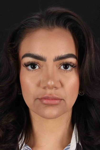 Rhinoplasty Before & After Patient #3192