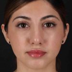 Rhinoplasty Before & After Patient #3214