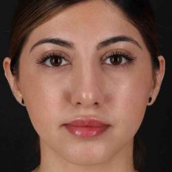 Rhinoplasty Before & After Patient #3214