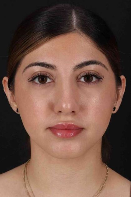 Rhinoplasty Before & After Patient #3214