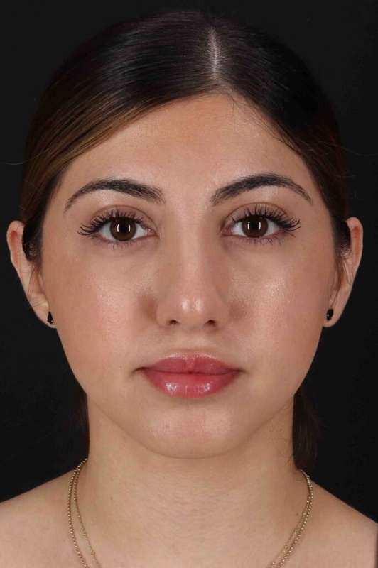 Rhinoplasty Before & After Patient #3214