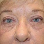 Browlift Before & After Patient #1414