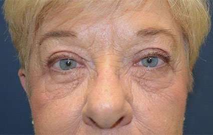 Browlift Before & After Patient #1414