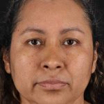 Rhinoplasty Before & After Patient #3225