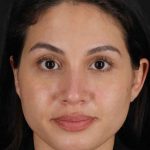 Rhinoplasty Before & After Patient #3236