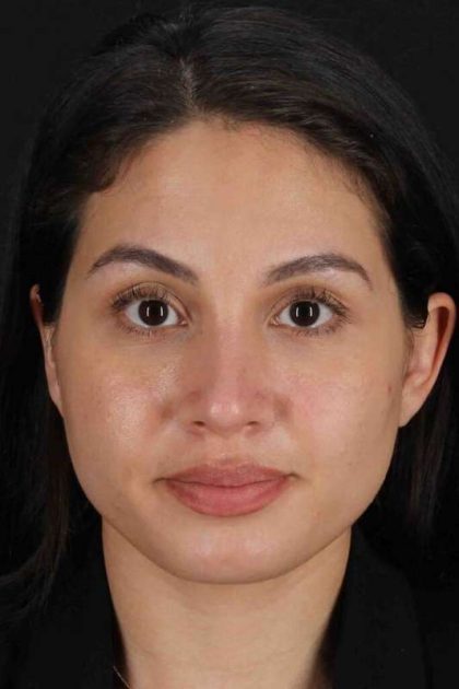 Rhinoplasty Before & After Patient #3236