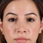 Rhinoplasty Before & After Patient #3247
