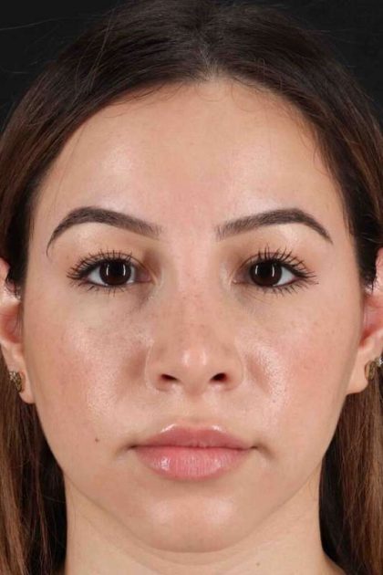 Rhinoplasty Before & After Patient #3247