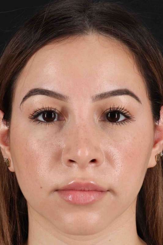 Rhinoplasty Before & After Patient #3247