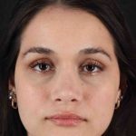 Rhinoplasty Before & After Patient #3258