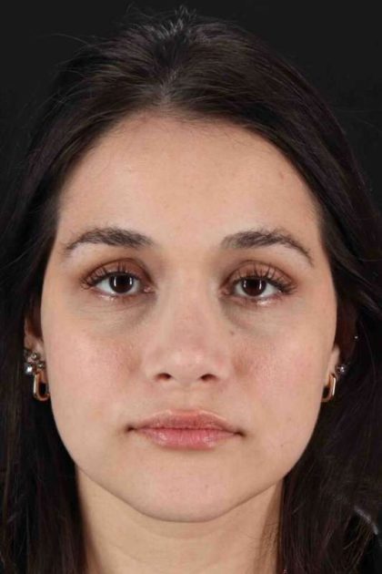 Rhinoplasty Before & After Patient #3258