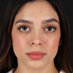 Rhinoplasty Before & After Patient #3269