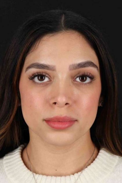 Rhinoplasty Before & After Patient #3269