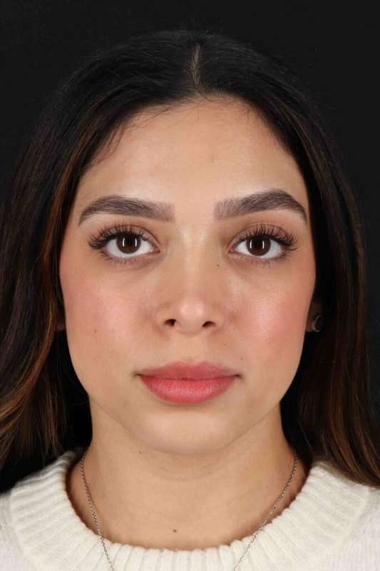 Rhinoplasty Before & After Patient #3269