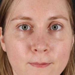 Rhinoplasty Before & After Patient #3280