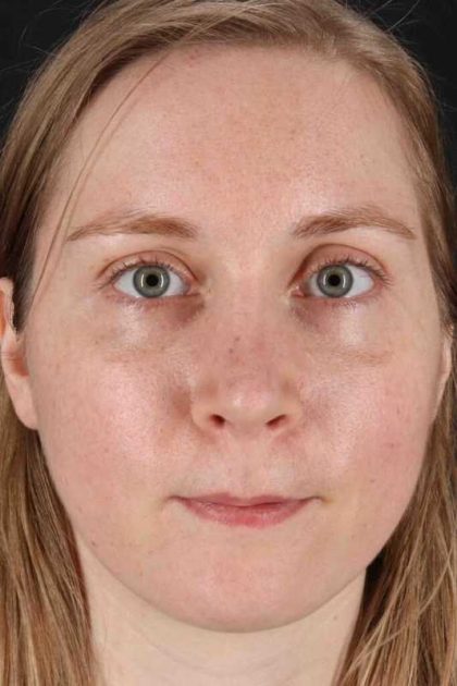 Rhinoplasty Before & After Patient #3280