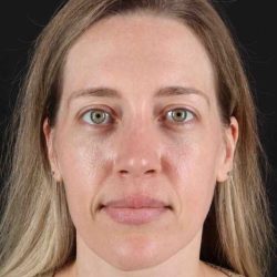 Rhinoplasty Before & After Patient #3291