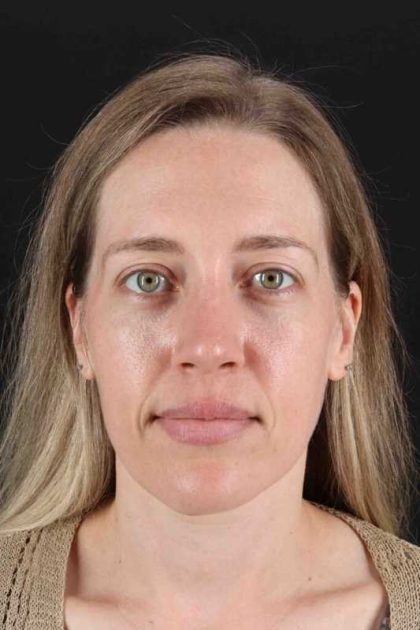 Rhinoplasty Before & After Patient #3291