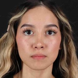 Rhinoplasty Before & After Patient #3302