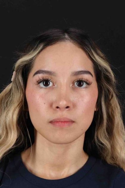 Rhinoplasty Before & After Patient #3302