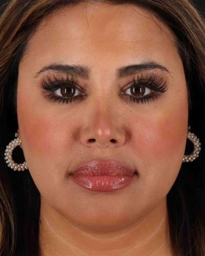 Rhinoplasty Before & After Patient #3324