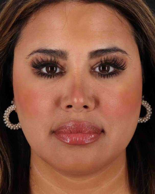 Rhinoplasty Before & After Patient #3324