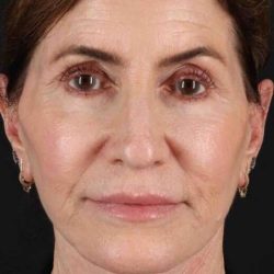 Co2 Laser Before & After Patient #3346