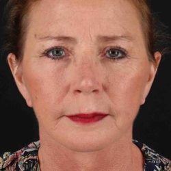 Co2 Laser Before & After Patient #3368