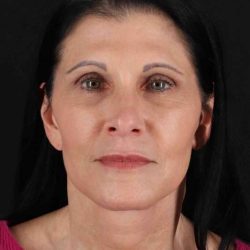 Co2 Laser Before & After Patient #3379