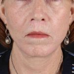 Submental Liposuction Before & After Patient #3401