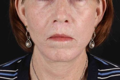 Submental Liposuction Before & After Patient #3401