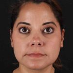 Buccal Fat Pad Before & After Patient #1436