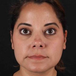 Buccal Fat Pad Before & After Patient #1436