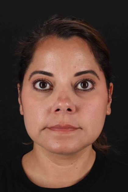 Buccal Fat Pad Before & After Patient #1436