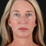 Upper Blepharoplasty Before & After Patient #3434