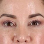 Upper Blepharoplasty Before & After Patient #3445